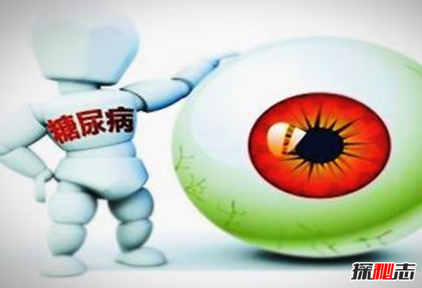 糖尿病發(fā)病率最低的10個(gè)國(guó)家 烏克蘭上榜,第一猜不到