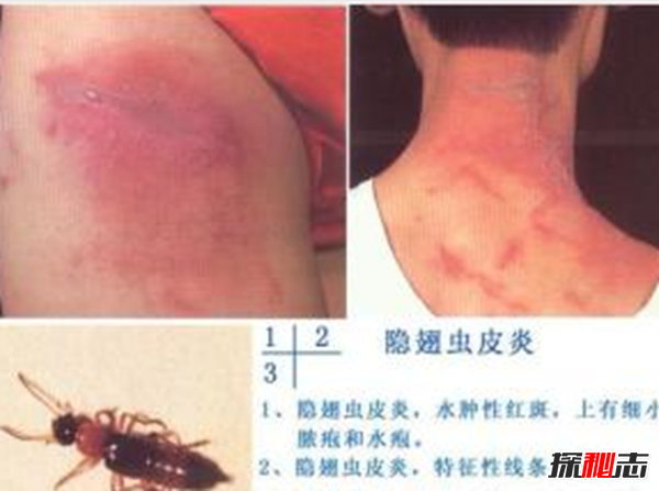 硫酸蟻是什么?怎樣預(yù)防硫酸蟻(發(fā)育完全變態(tài)夏秋最為常見(jiàn))