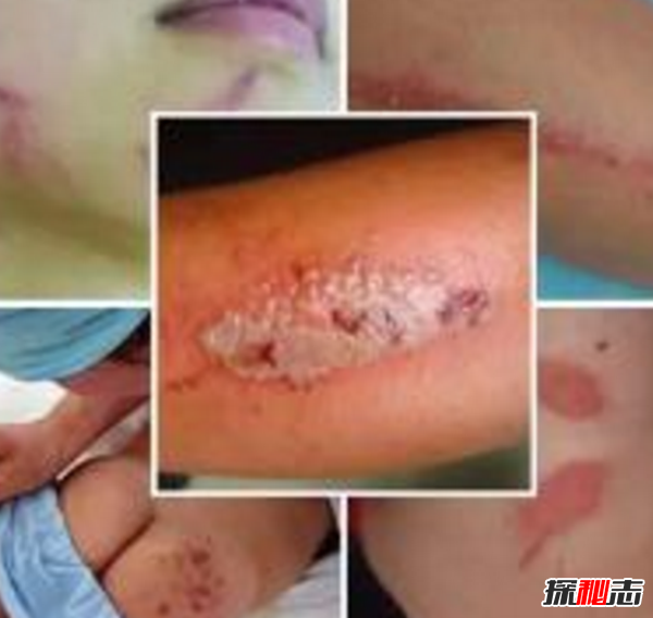 硫酸蟻是什么?怎樣預(yù)防硫酸蟻(發(fā)育完全變態(tài)夏秋最為常見(jiàn))